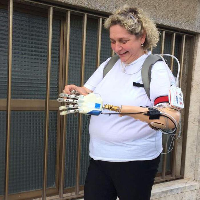Mano bionica impiantata in una donna italiana