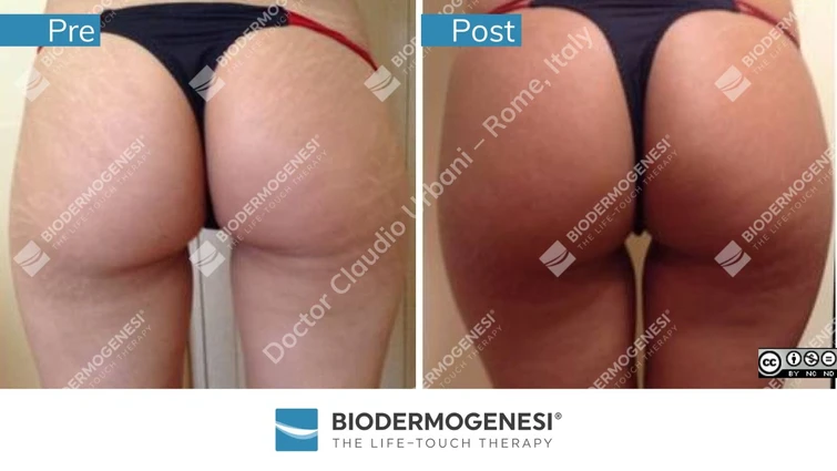 Biodermogenesi il trattamento indolore che elimina le smagliature Le foto prima e dopo