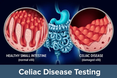 Celiachia cereali e intolleranza al glutine tra verità e falsi miti