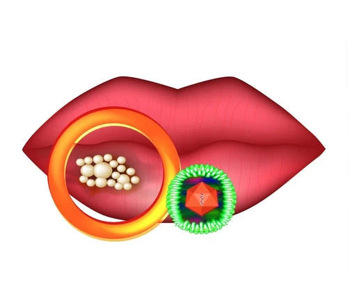 Contrastare afte e herpes labiale farmaci prevenzione e rimedi naturali