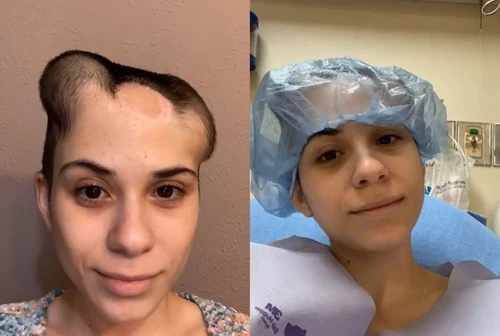 A soli 24 anni il tumore la sfigura la battaglia di Alondra che si mostra prima e dopo la lotta al cancro