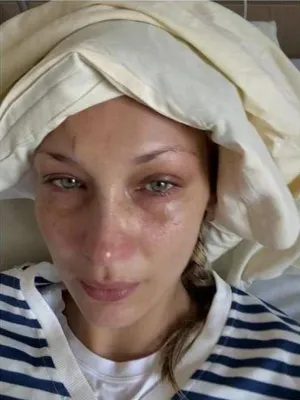 Bella Hadid in ospedale (Instagram)